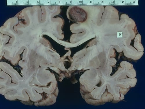 Medulloblastoma, la fenformina può contrastarlo