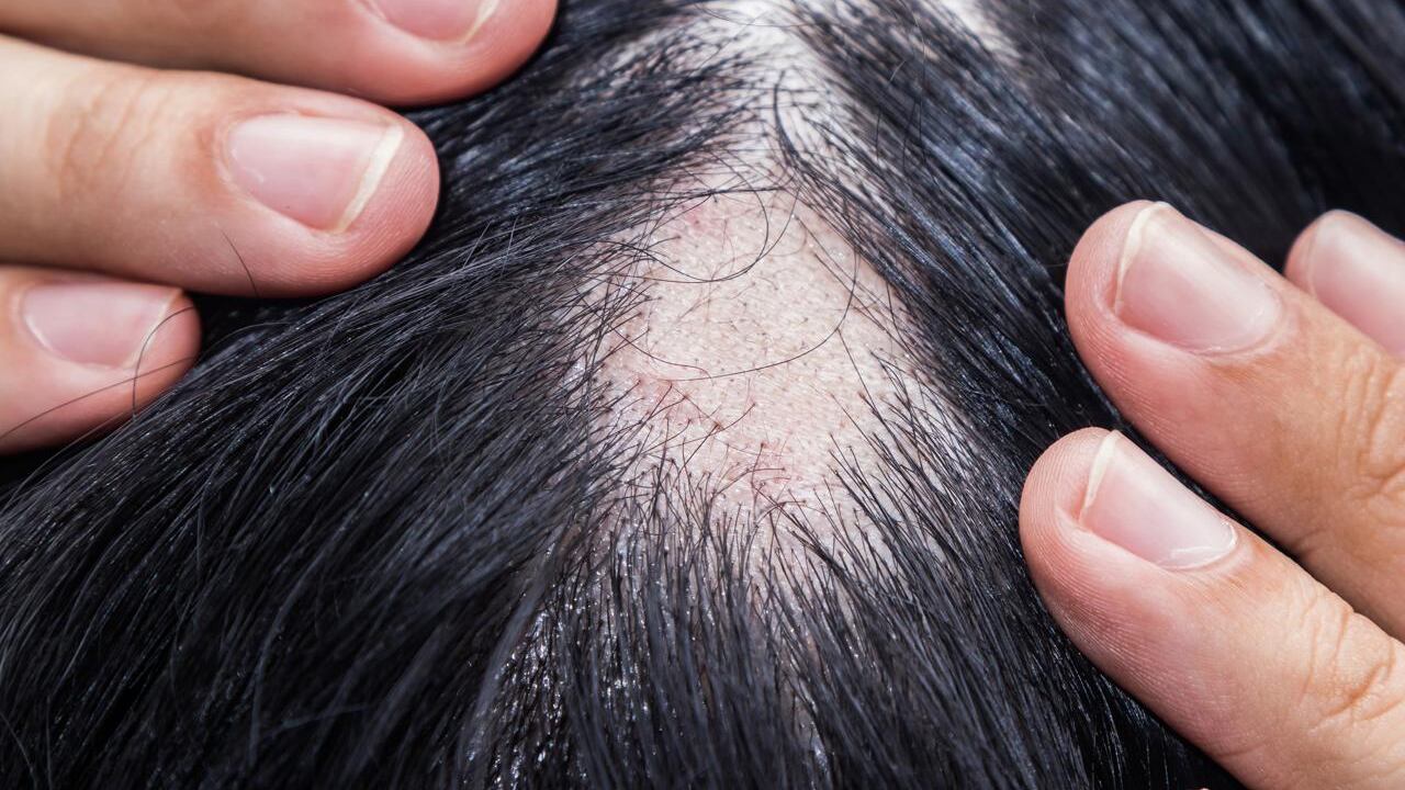 Alopecia areata, ok Aifa a rimborsabilità nuovo trattamento