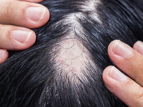 Alopecia areata, ok Aifa a rimborsabilità nuovo trattamento