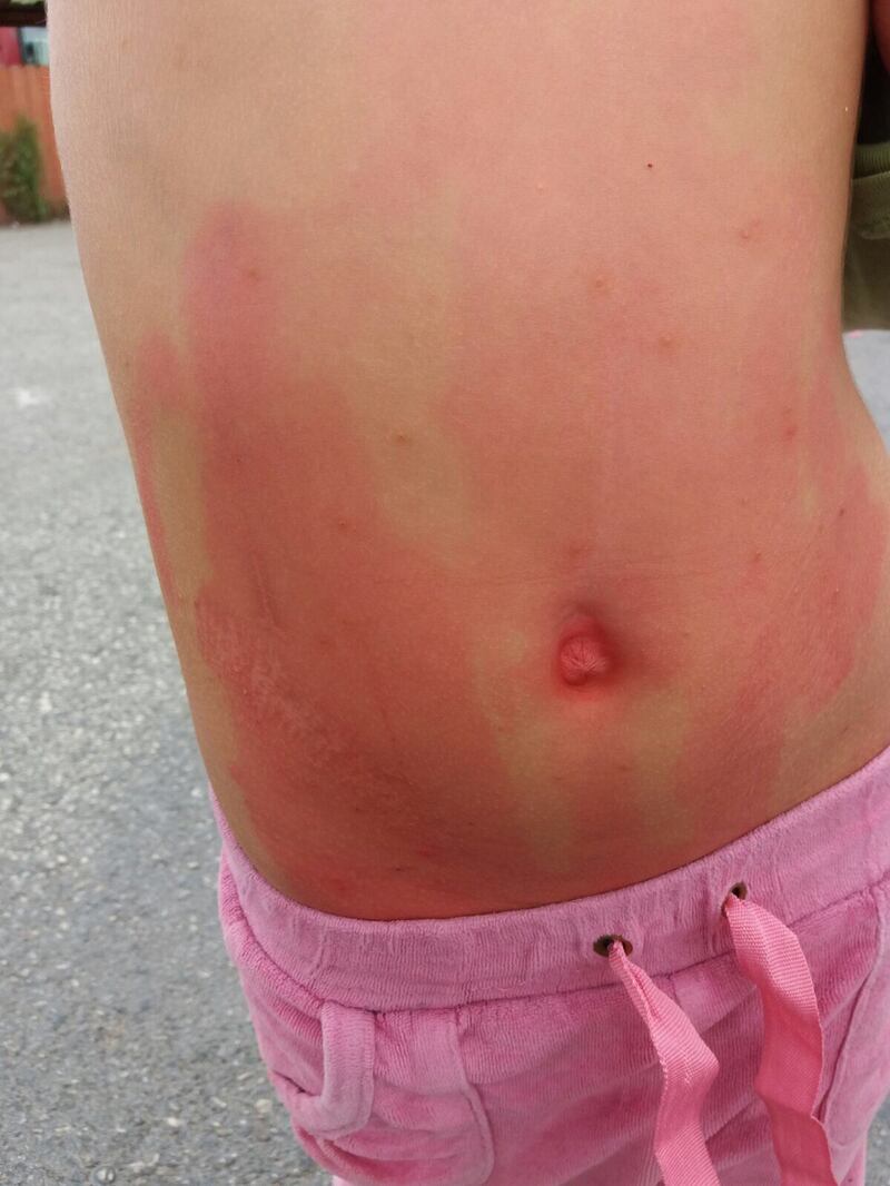 Bimbi rom con la scabbia nel campo nomadi di Castel Romano 6