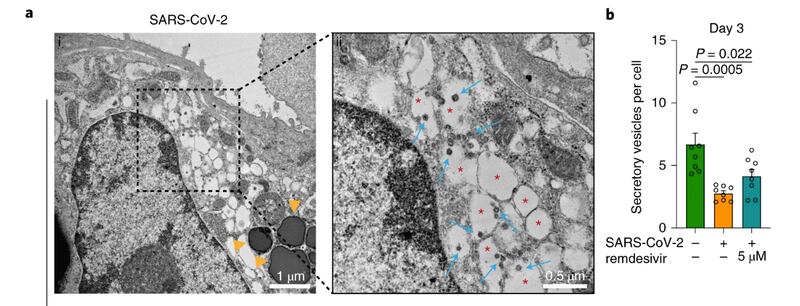 Sars-Cov-2 infetta e si replica nelle cellule del pancreas endocrino ed esocrino umano