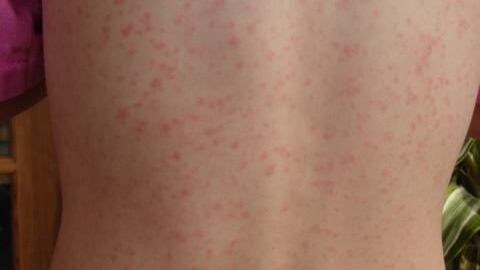 Scarlattina, prevenzione e cure: quali sono i sintomi e le modalità di contagio