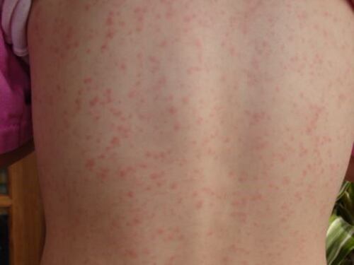 Scarlattina, prevenzione e cure: quali sono i sintomi e le modalità di contagio