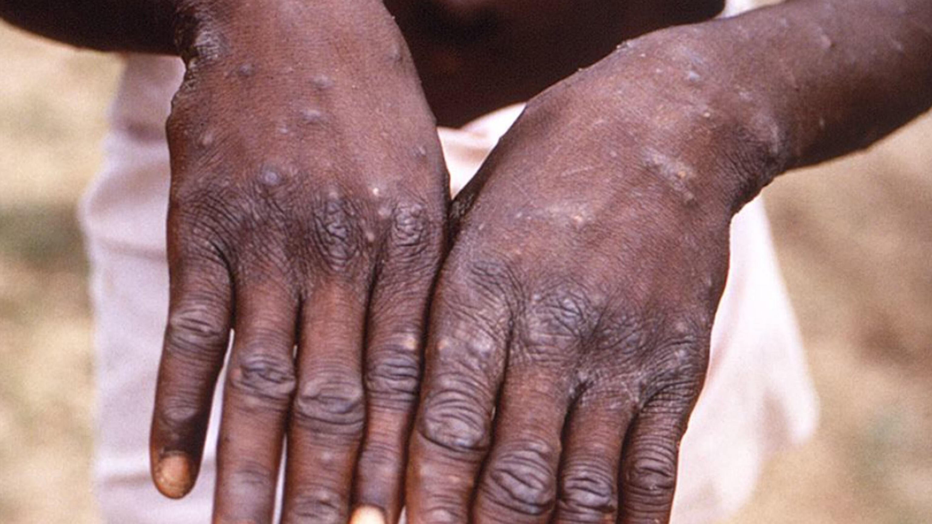 Ecco le linee guida per evitare il vaiolo delle scimmie