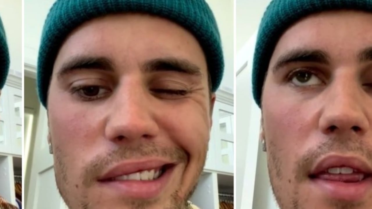 La sindrome di Hunt: ecco cos'è la paralisi di cui soffre Justin Bieber