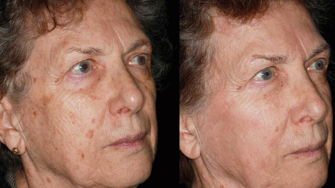 Lotta al fotoinvecchiamento per ritrovare una pelle luminosa