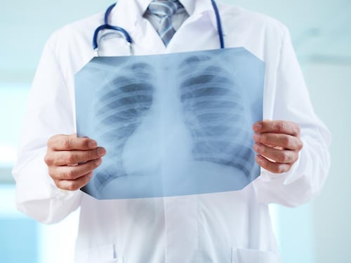 Adenocarcinoma polmonare: cos’è il tumore asportato a Papa Leone XIV