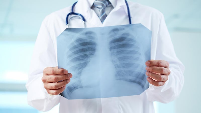 Adenocarcinoma polmonare: cos’è il tumore asportato a Papa Leone XIV