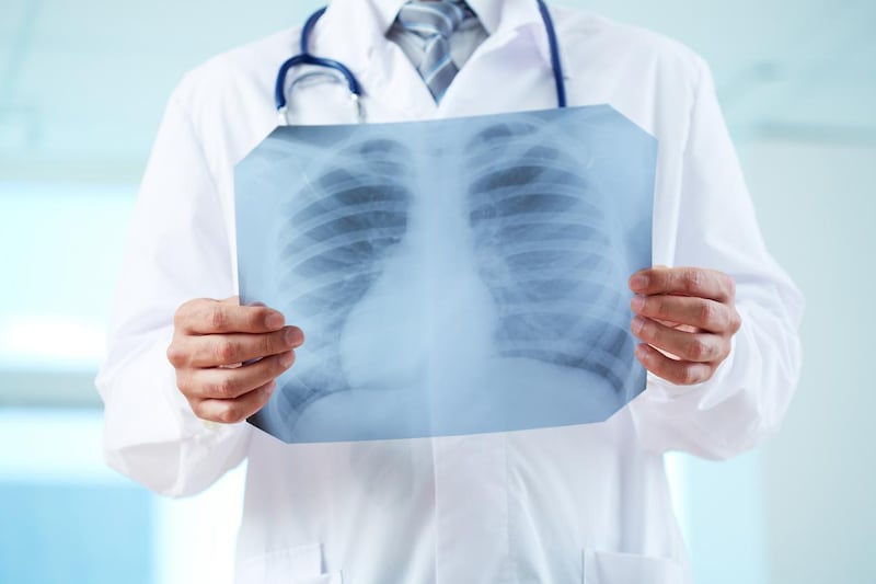 Adenocarcinoma polmonare: cos’è il tumore asportato a Papa Leone XIV