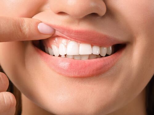 Recessione gengivale: di cosa si tratta e come curarla