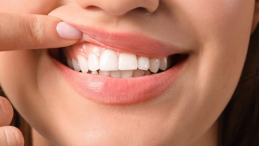 Recessione gengivale: di cosa si tratta e come curarla