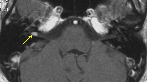 Neurinoma acustico, cos'è e come si manifesta?