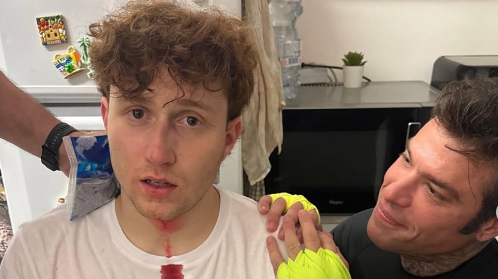Fedez rompe il naso al Rosso in diretta, la corsa in ospedale: cosa è successo