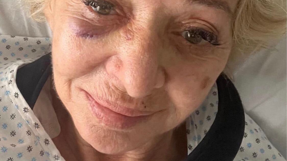 "Sono caduta di faccia". Enrica Bonaccorti mostra il volto tumefatto