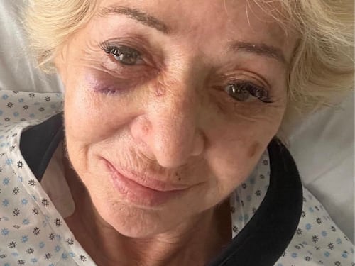 "Sono caduta di faccia". Enrica Bonaccorti mostra il volto tumefatto