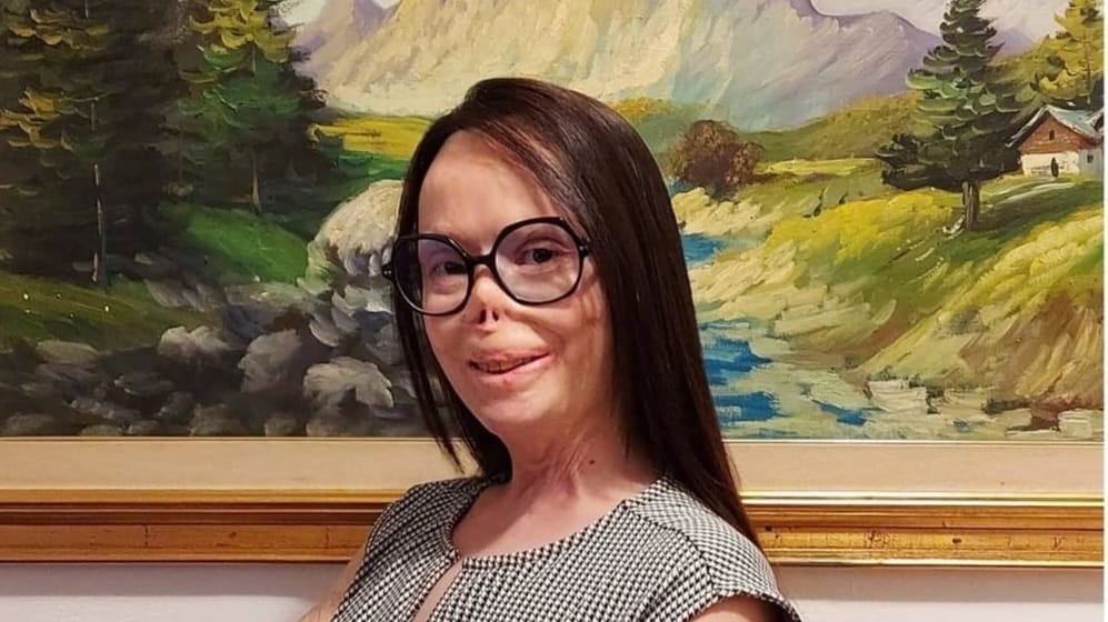 Valentina Pitzalis: "Il mio ex mi ha dato fuoco, ma io non ho perso il sorriso"