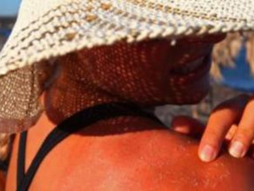 Eritema solare, i rimedi naturali per combatterlo