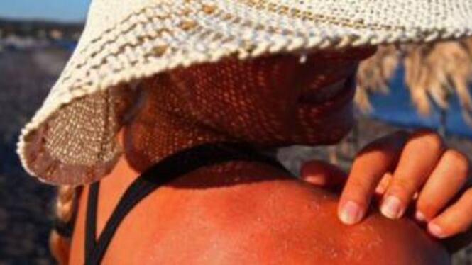 Eritema solare, i rimedi naturali per combatterlo