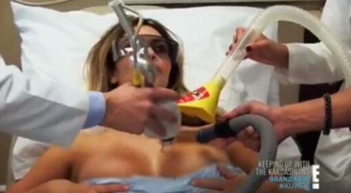 Kim Kardashian, laser sul seno per rimuovere le smagliature 1