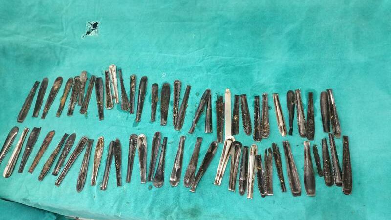I medici gli trovano 63 cucchiai nello stomaco: cosa è successo all’indiano