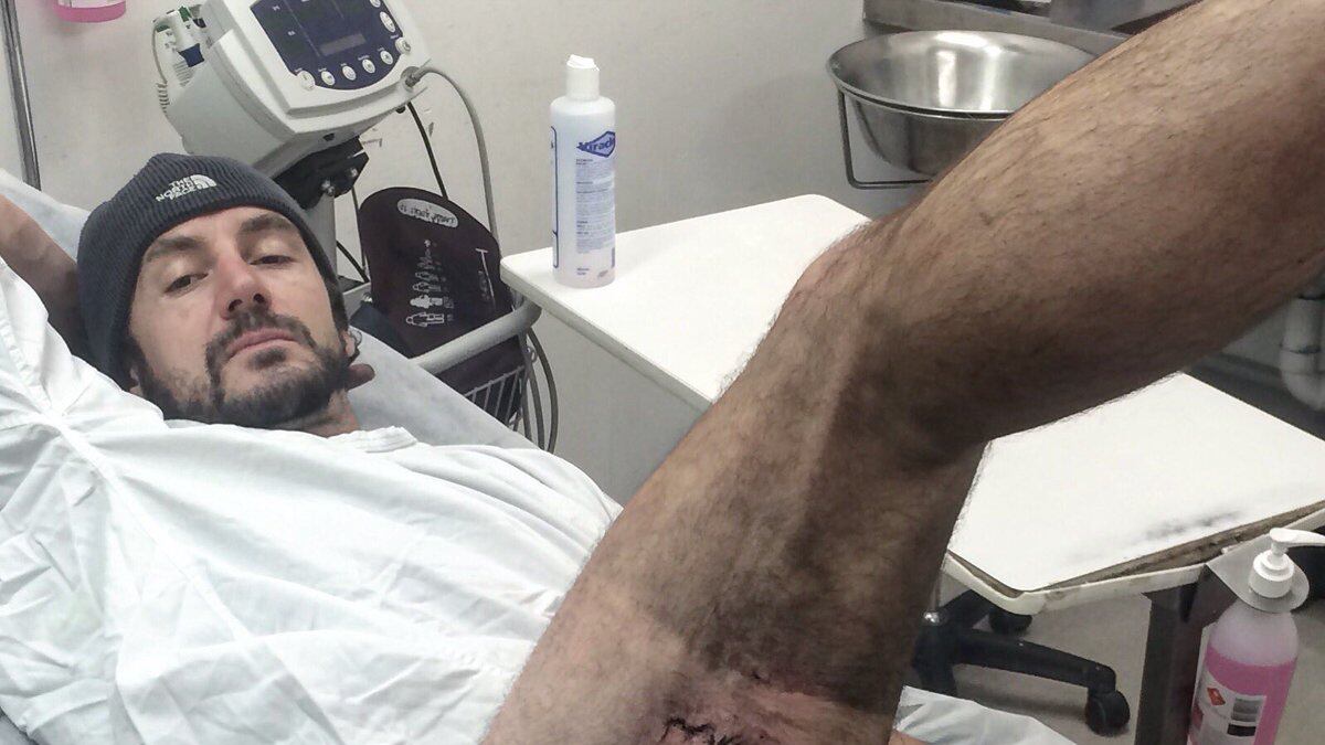 Cade dalla bici e il suo iPhone esplode: ciclista rimane ustionato