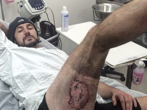 Cade dalla bici e il suo iPhone esplode: ciclista rimane ustionato