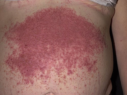 Dermatite erpetiforme, quali sono le cause