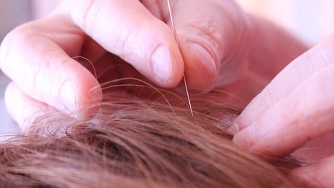 L’agopuntura può servire ad alleviare i disturbi della menopausa