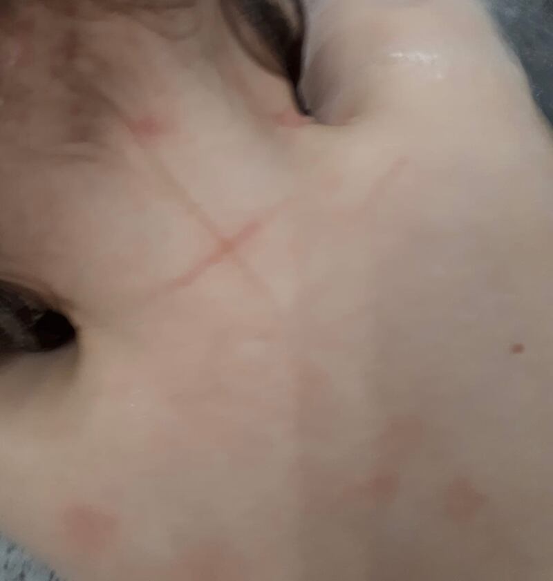 Quei lividi sospetti sul corpo dei bimbi dell'asilo Isola dei Tesori 3