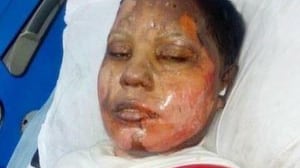 È morta Asma, giovane cristiana arsa viva in Pakistan