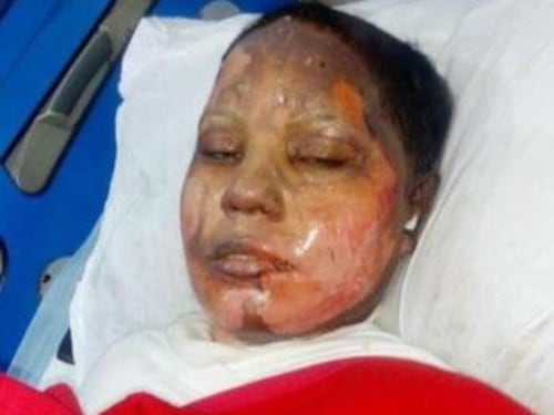 È morta Asma, giovane cristiana arsa viva in Pakistan