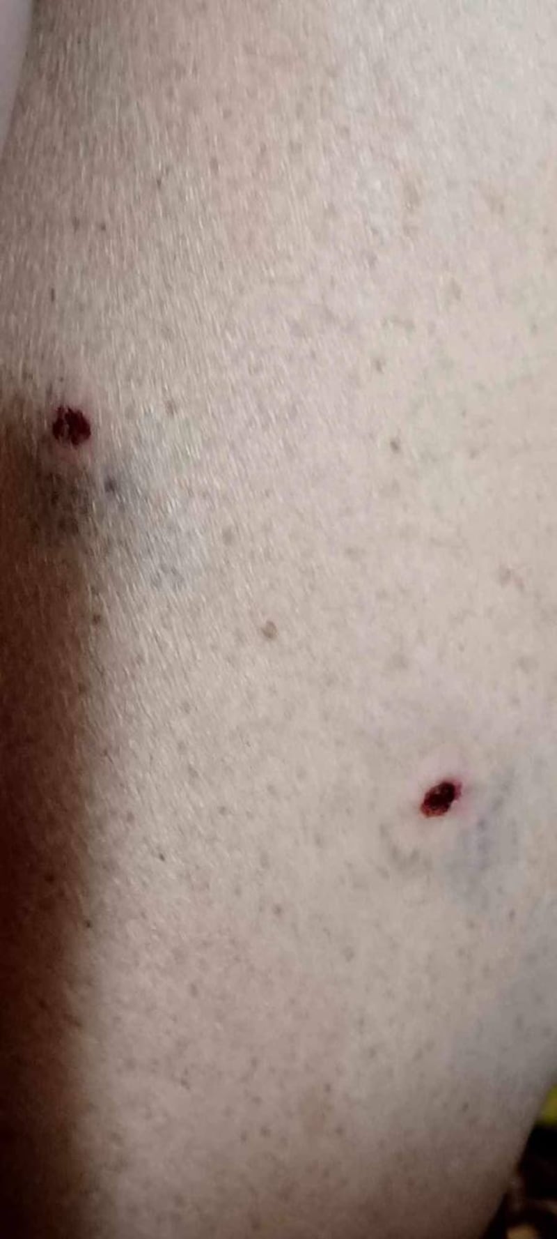 La gamba della compagna di Dudog dopo l'aggressione.