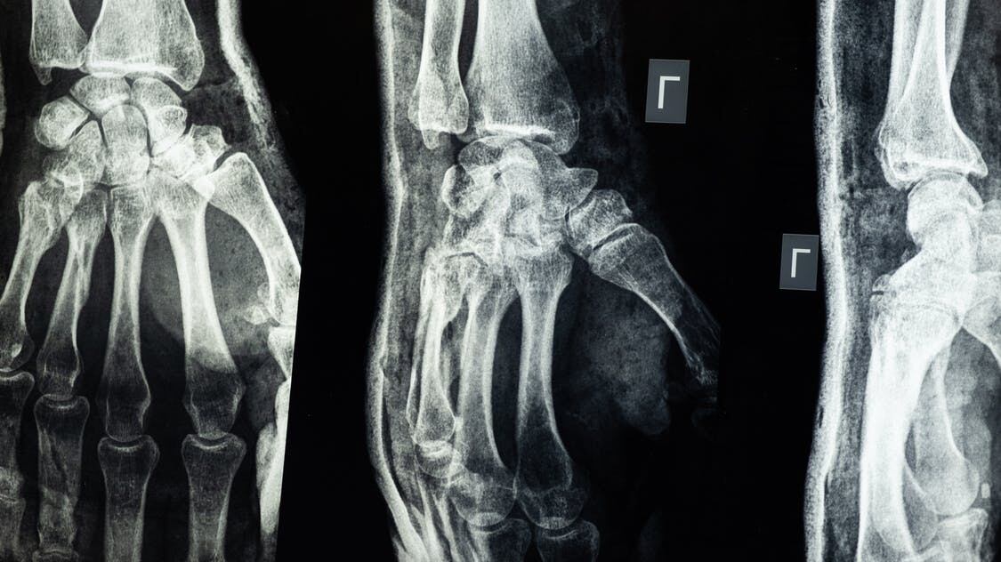 Protesi ortopediche, un tatuaggio elettronico ne monitora la salute