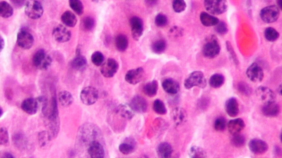 Mieloma multiplo, il nuovo farmaco che dà speranza