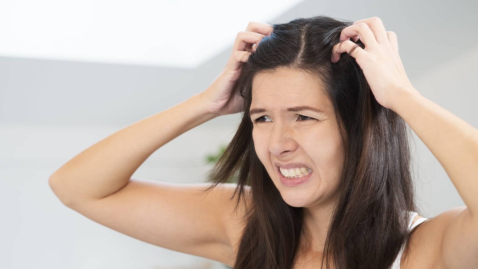 I rimedi naturali per combattere la dermatite seborroica