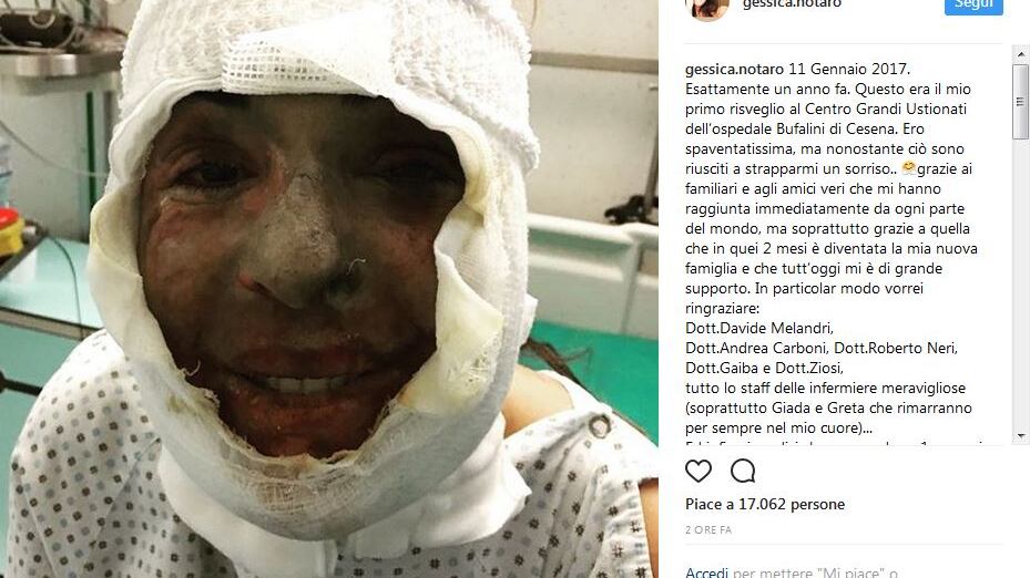 Gessica Notaro posta il primo selfie scattato dopo l'agguato dell'ex