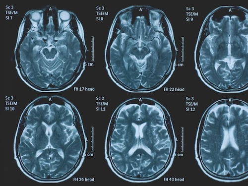 Una persona su 3 ha un disturbo neurologico, a Napoli arriva BrainSpace House