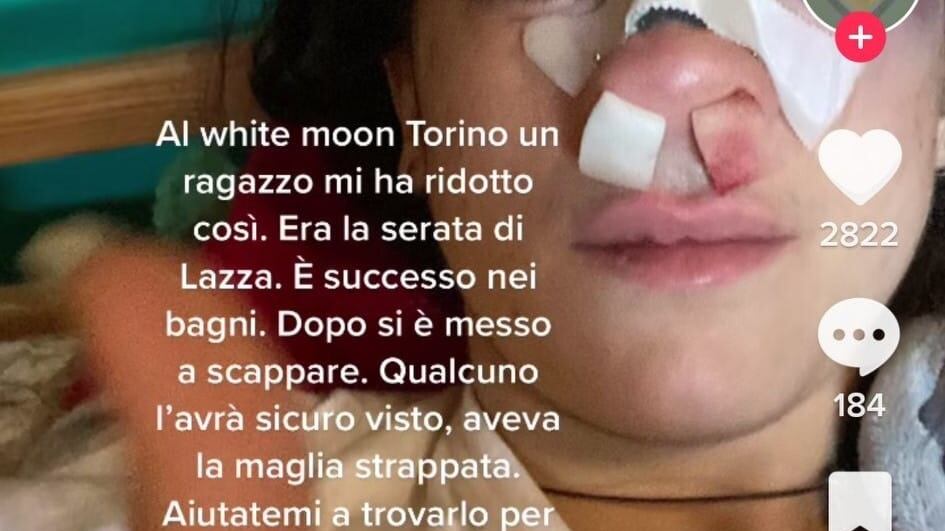 Difende il fidanzato e le rompono il naso: "Aiutatemi a trovarli"