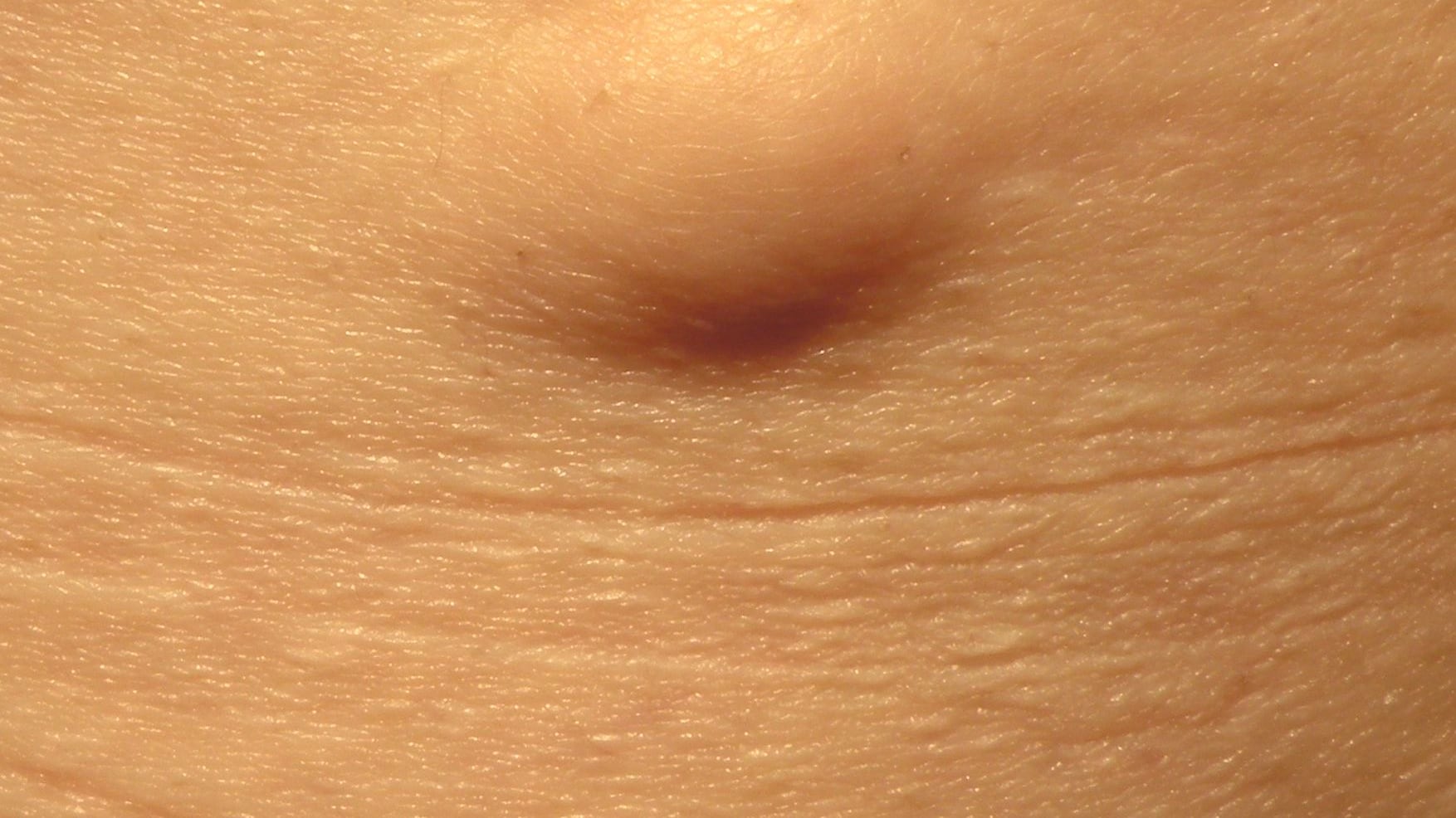 Lipoma, quali sono i sintomi e come si cura