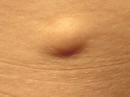 Lipoma, quali sono i sintomi e come si cura