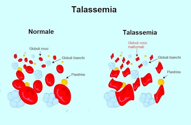 talassemia