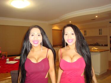 Australia, chirurgo rende perfettamente identiche due gemelle 1