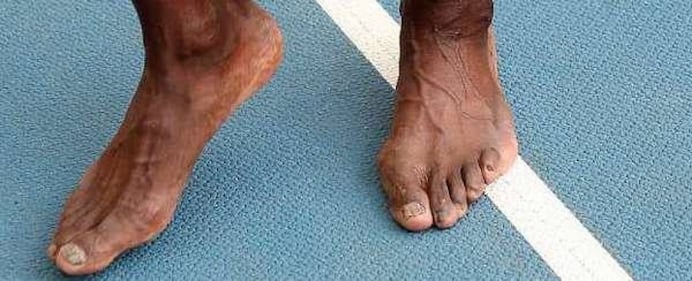 I piedi di Bolt, veloci e del tutto rovinati 1