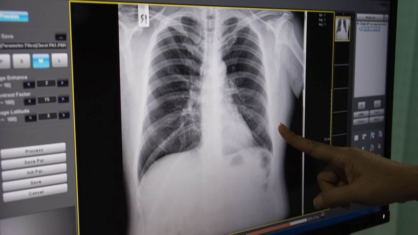 Gambiano affetto da Tbc torna in ospedale: paura per il contagio