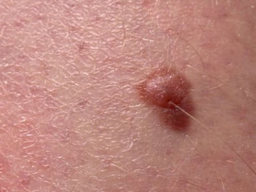 Un nuovo test del sangue per identificare il melanoma