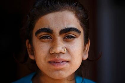 Nepal, soffrono di una malattia che li rende pelosissimi 17