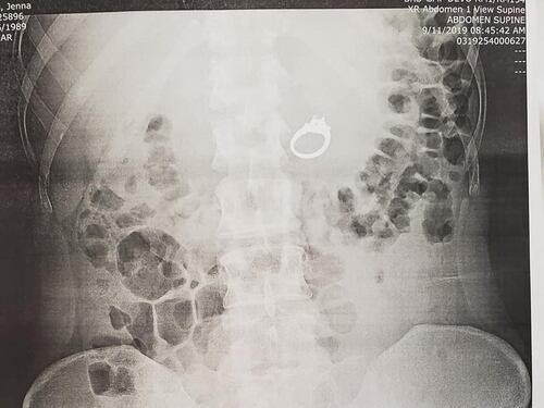 Sogna di ingoiare l'anello: finisce in pronto soccorso