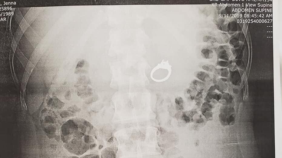 Sogna di ingoiare l'anello: finisce in pronto soccorso