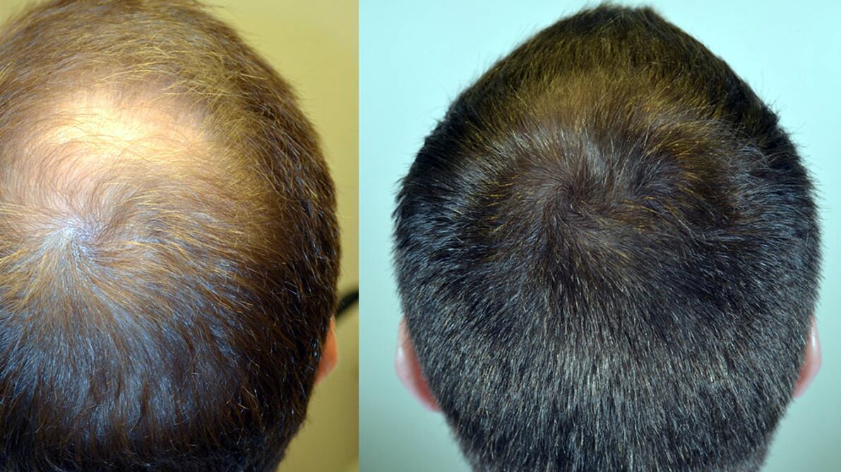 Caduta Capelli e Calvizie, le nostre cellule possono curarla senza chirurgia