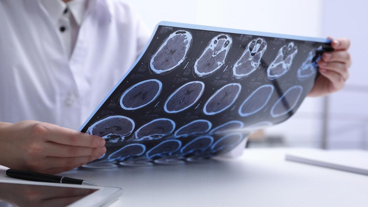 Sclerosi multipla, nuovi dati confermano efficacia cladribina a 4 anni